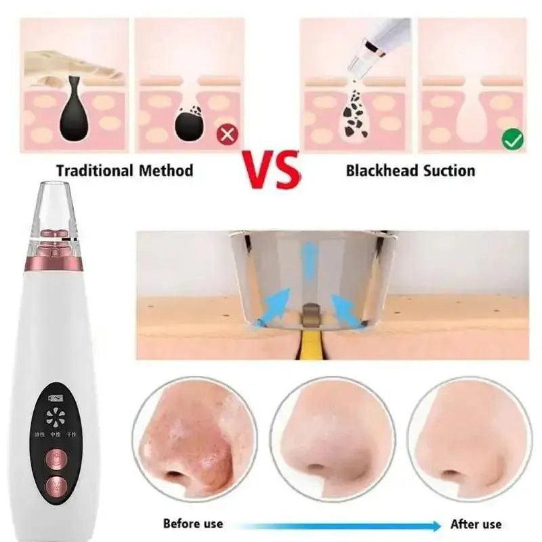 Multifunctional Cleaning Blackhead Remover Device - Image 4