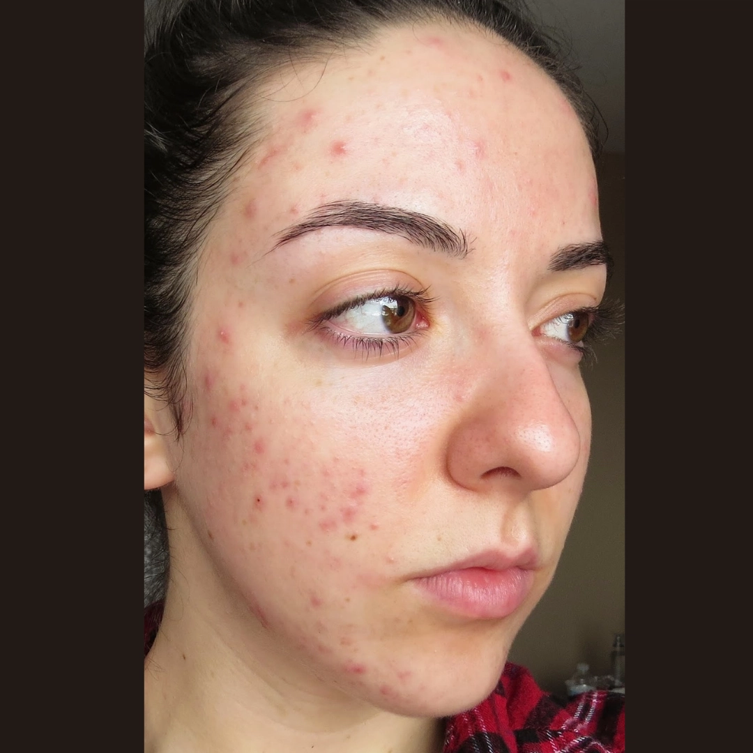 Dr. Althea 345 Relief Cream Pimple Face Photo